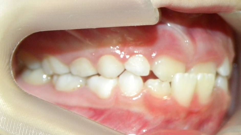 Lateral Derecha