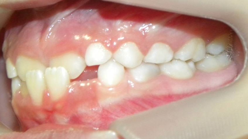 Lateral Izquierda