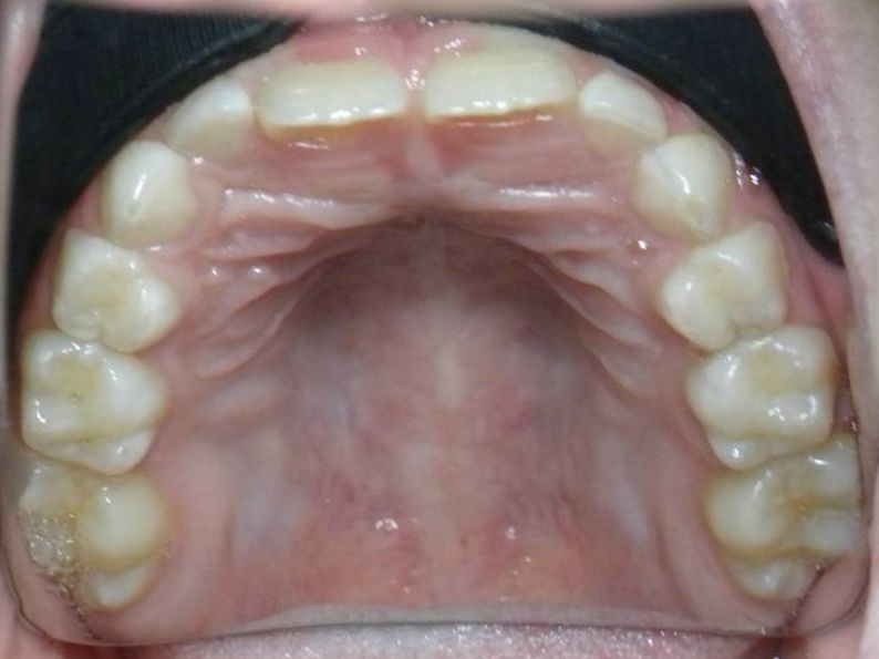 Oclusal Superior