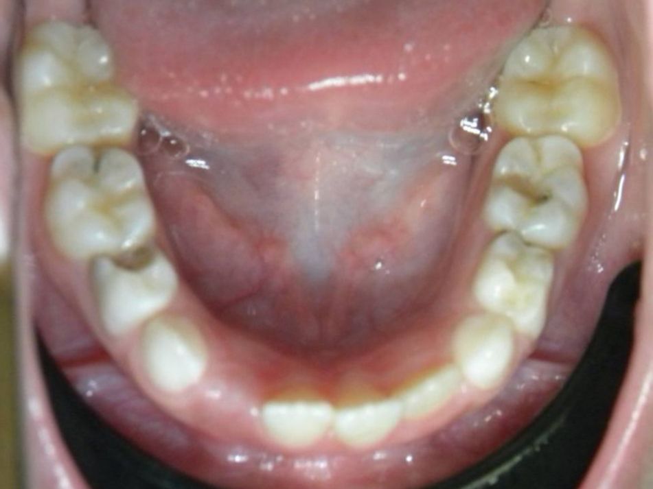Oclusal Inferior