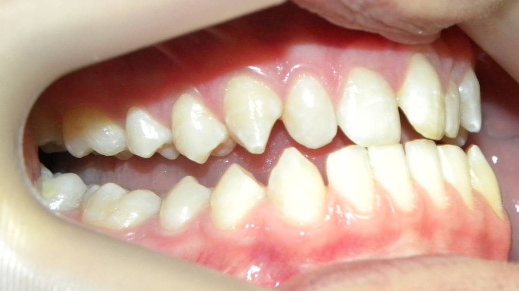 Lateral Derecha