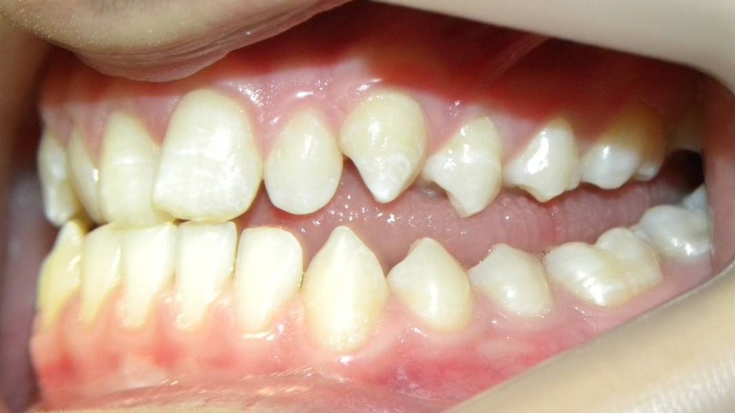 Lateral Izquierda