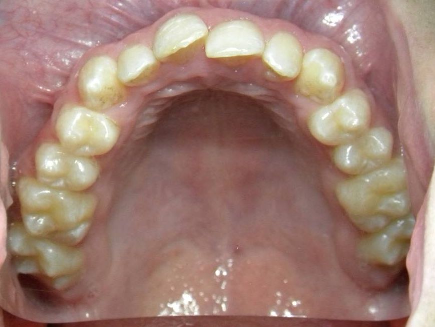 Oclusal Superior