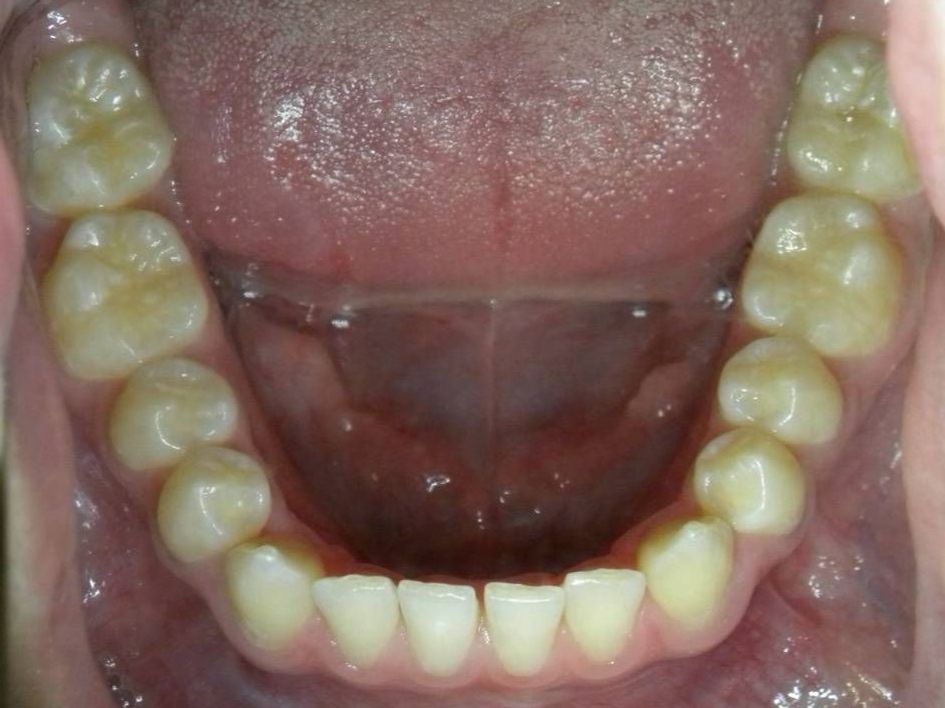 Oclusal Inferior