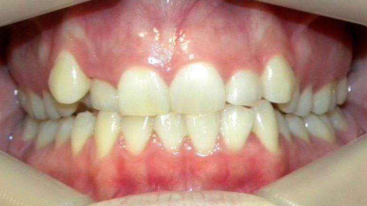 Frontal (Oclusión)