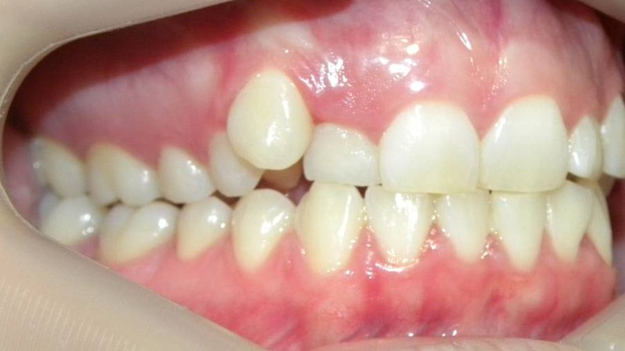 Lateral Derecha