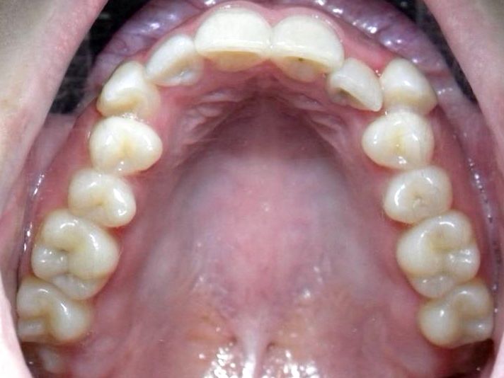 Oclusal Superior