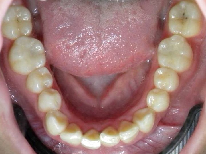 Oclusal Inferior