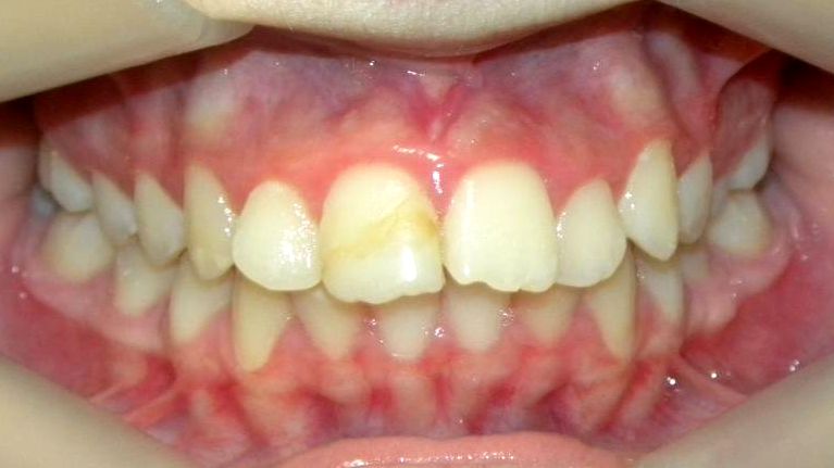 Frontal (Oclusión)