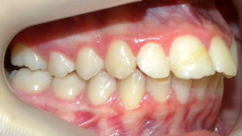 Lateral Derecha