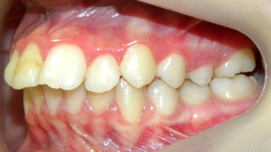 Lateral Izquierda