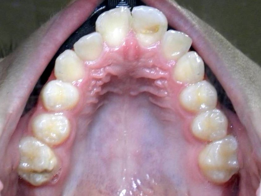 Oclusal Superior