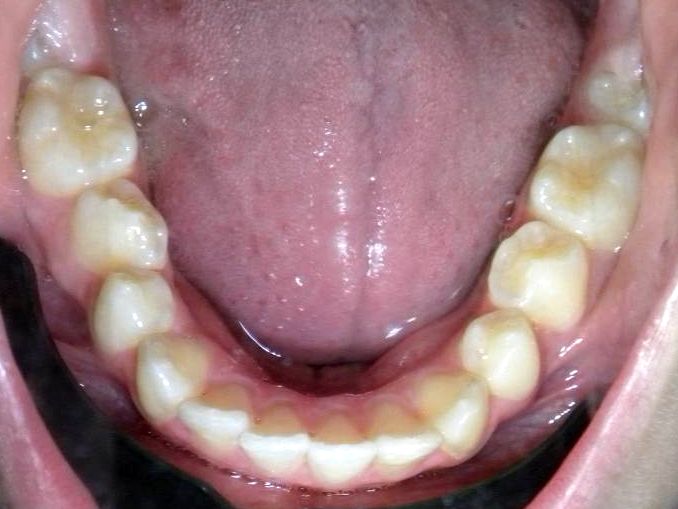Oclusal Inferior