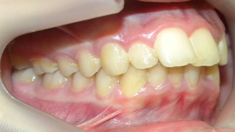 Lateral Derecha