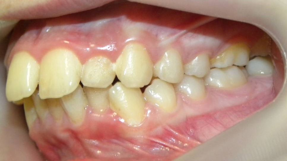 Lateral Izquierda
