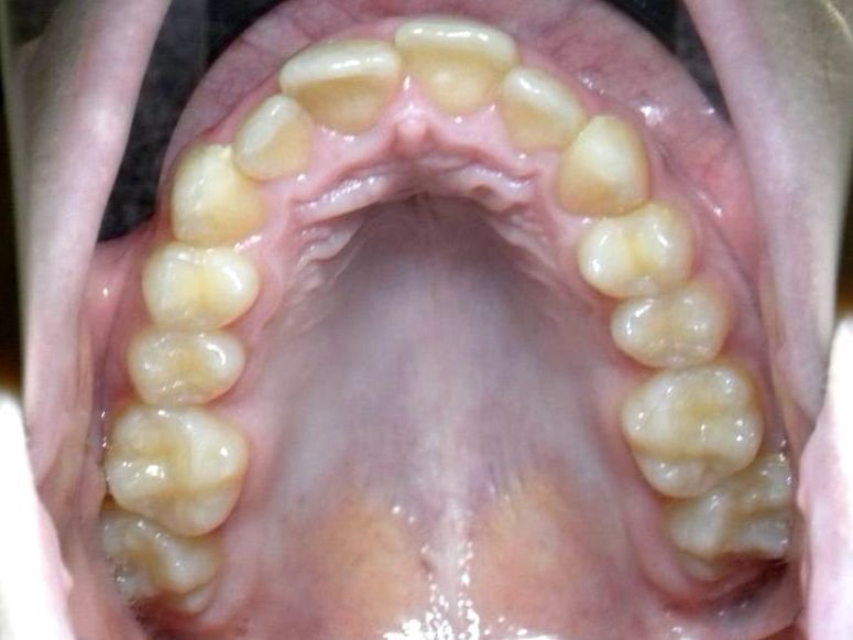 Oclusal Superior