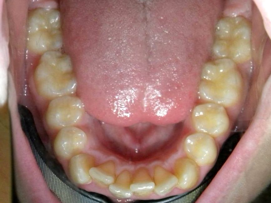 Oclusal Inferior
