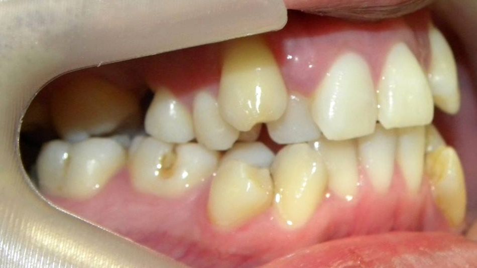 Lateral Derecha