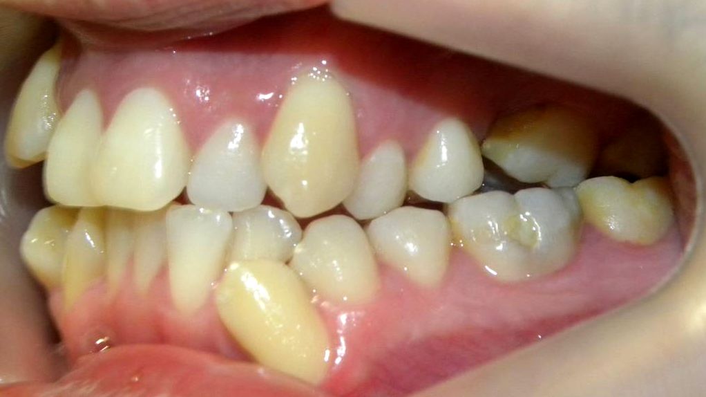 Lateral Izquierda