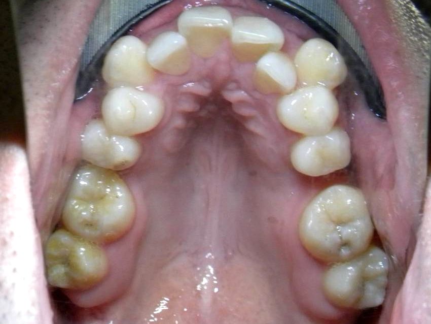 Oclusal Superior