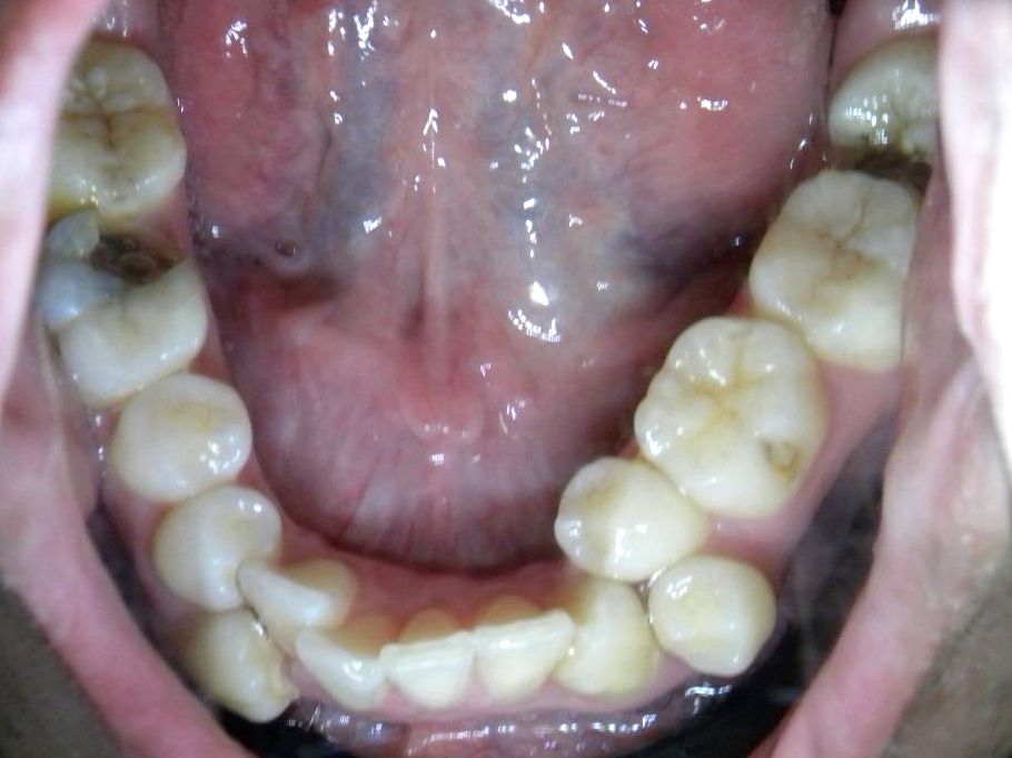 Oclusal Inferior