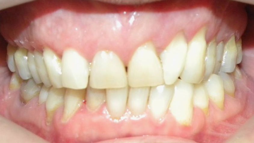 Frontal (Oclusión)