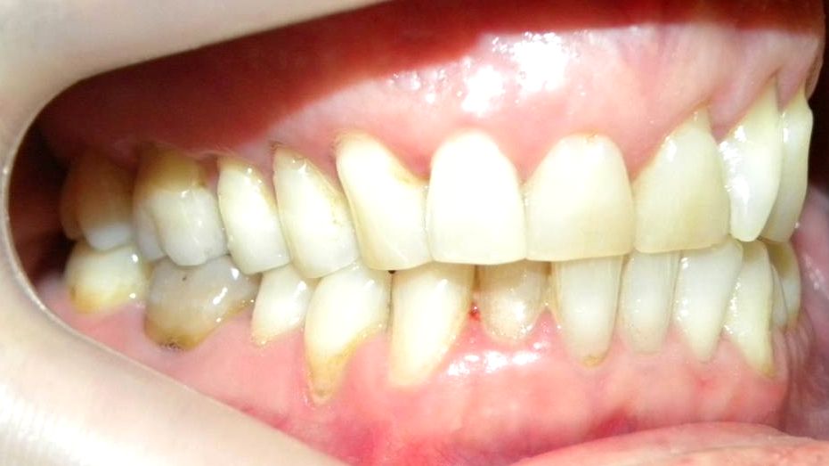 Lateral Derecha