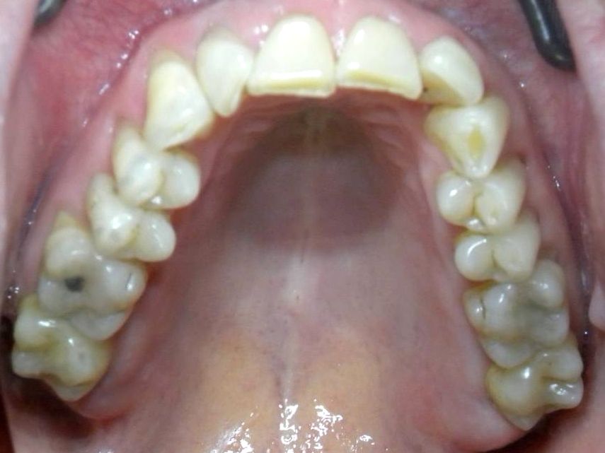Oclusal Superior
