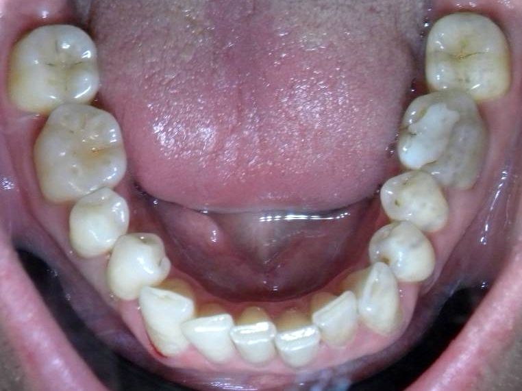 Oclusal Inferior