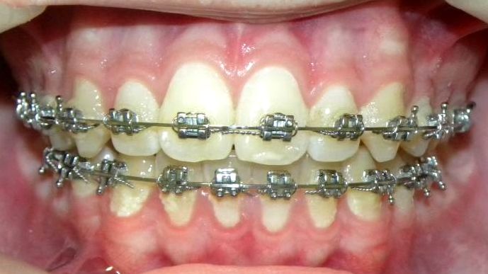 Frontal (Oclusión)