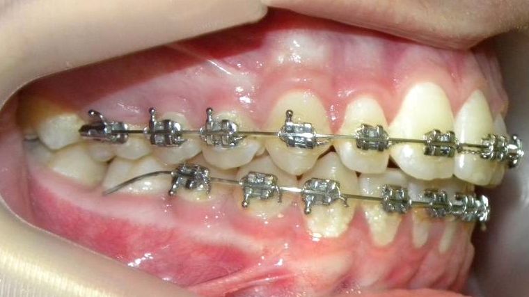 Lateral Derecha