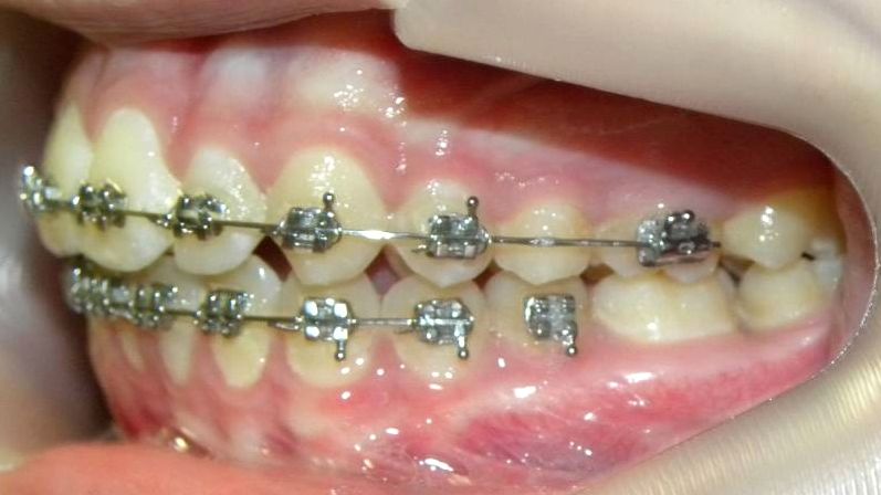 Lateral Izquierda