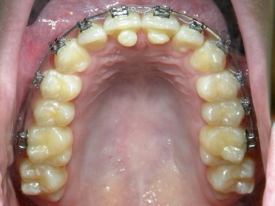 Oclusal Superior