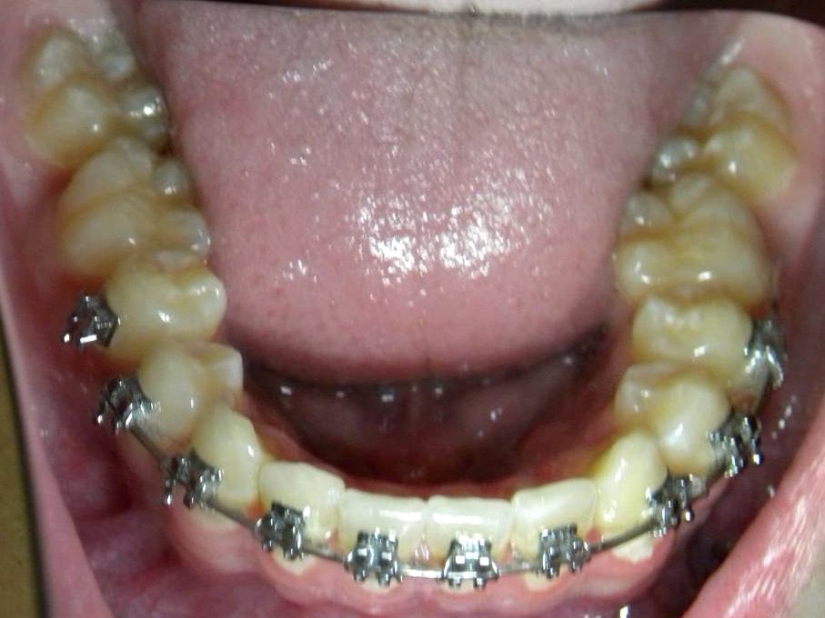 Oclusal Inferior