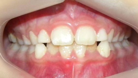Frontal (Oclusión)