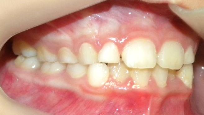 Lateral Derecha