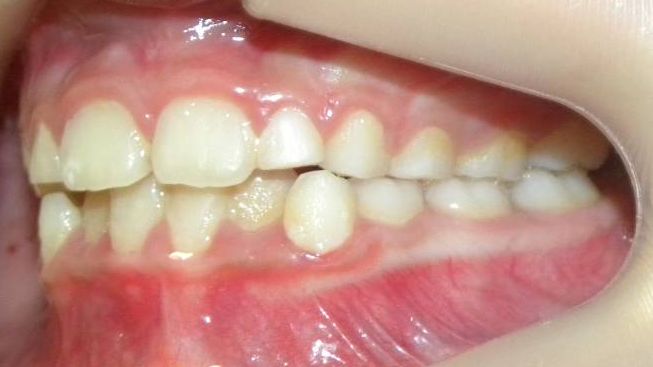 Lateral Izquierda