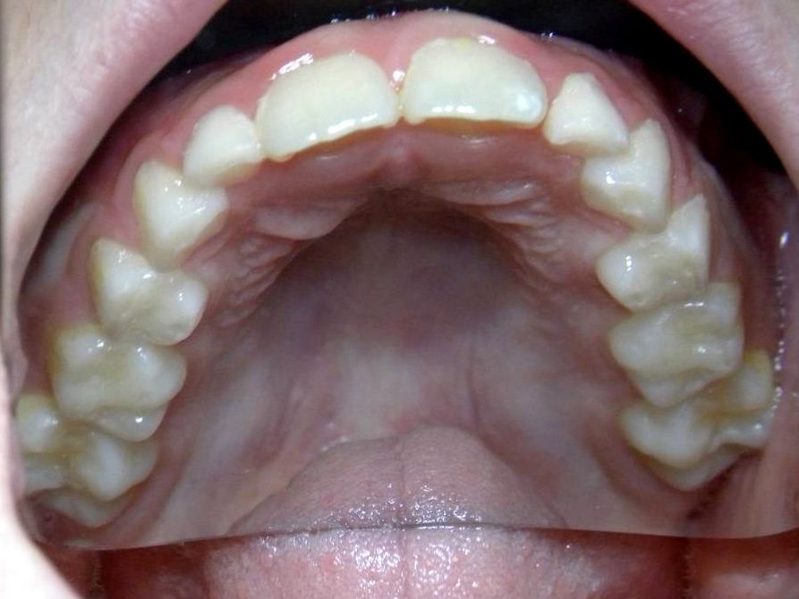 Oclusal Superior