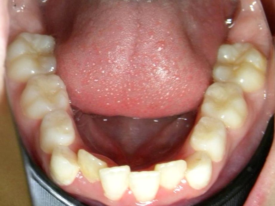 Oclusal Inferior