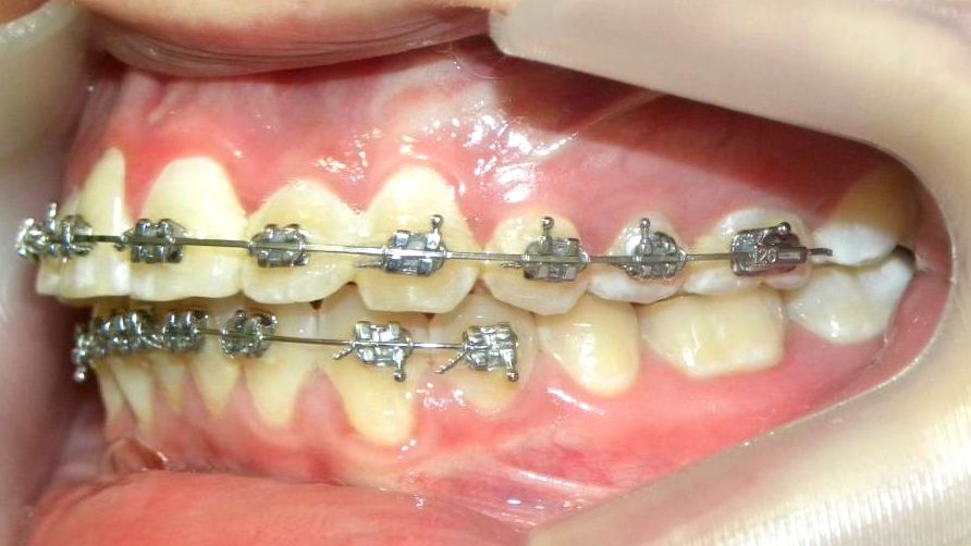 Lateral Izquierda