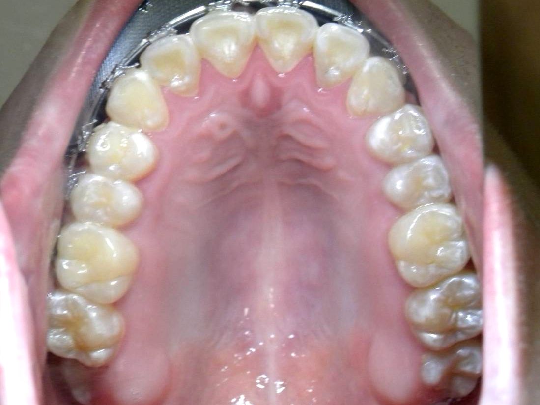 Oclusal Superior