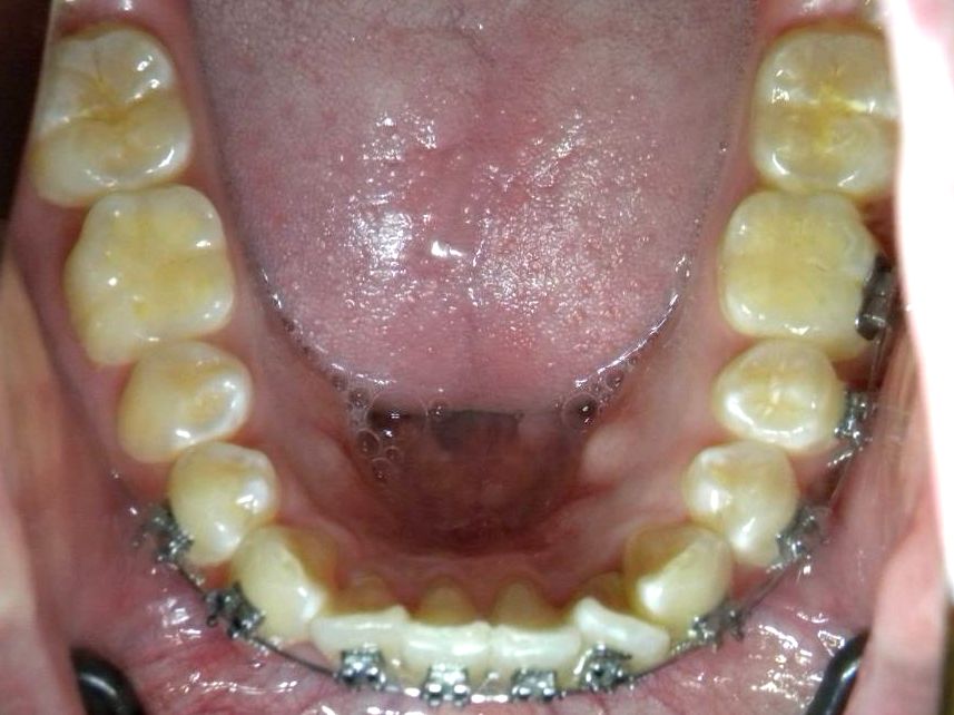 Oclusal Inferior