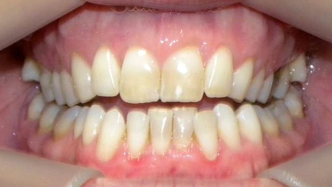 Frontal (Oclusión)