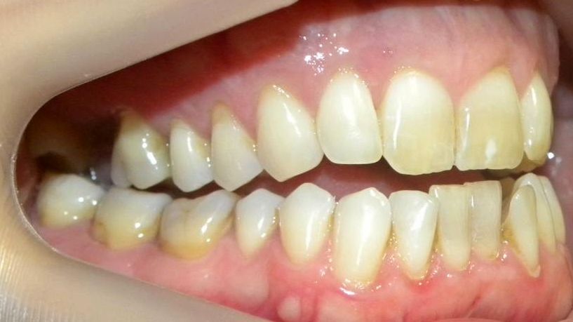 Lateral Derecha