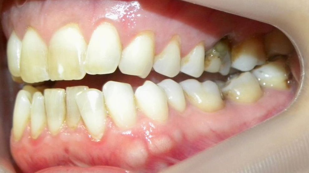 Lateral Izquierda