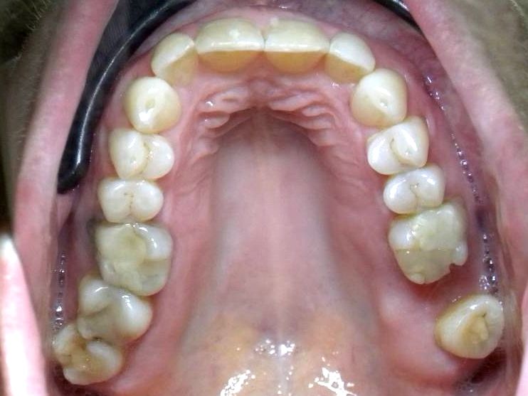Oclusal Superior