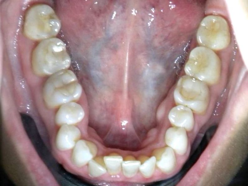Oclusal Inferior