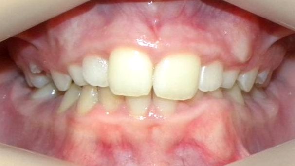 Frontal (Oclusión)