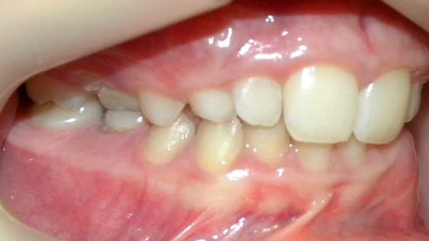 Lateral Derecha