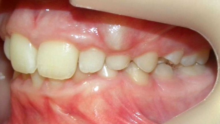Lateral Izquierda